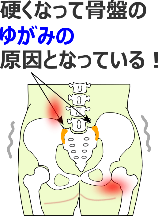 硬くなって骨盤のゆがみの原因となっている