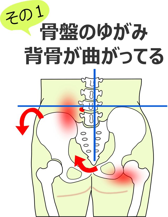 骨盤のゆがみと背骨が曲がっている