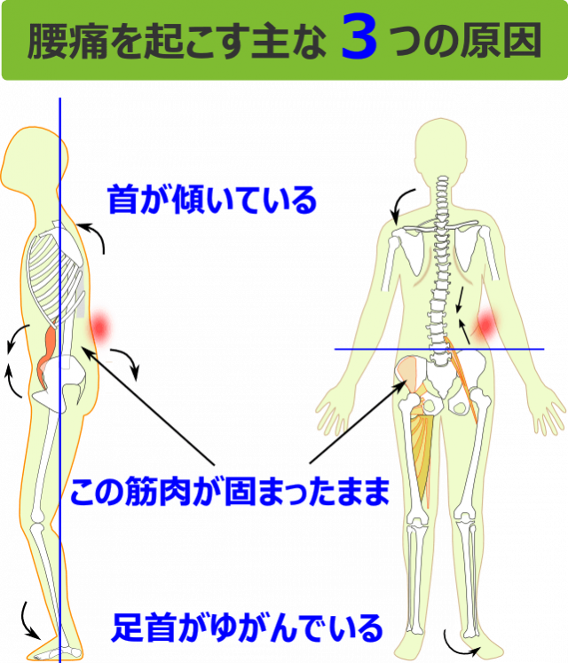 腰痛を起こす主な３つの原因