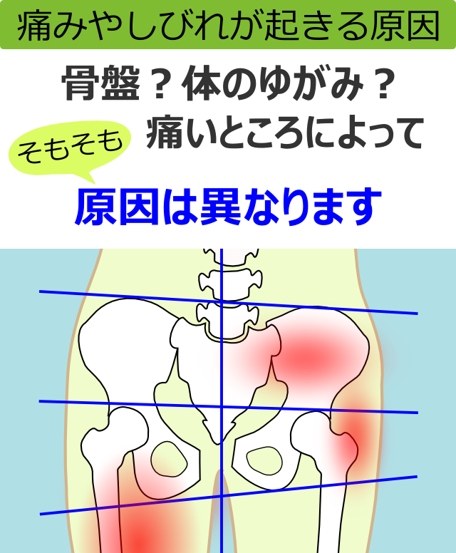 坐骨神経痛の痛みやしびれ起きる原因