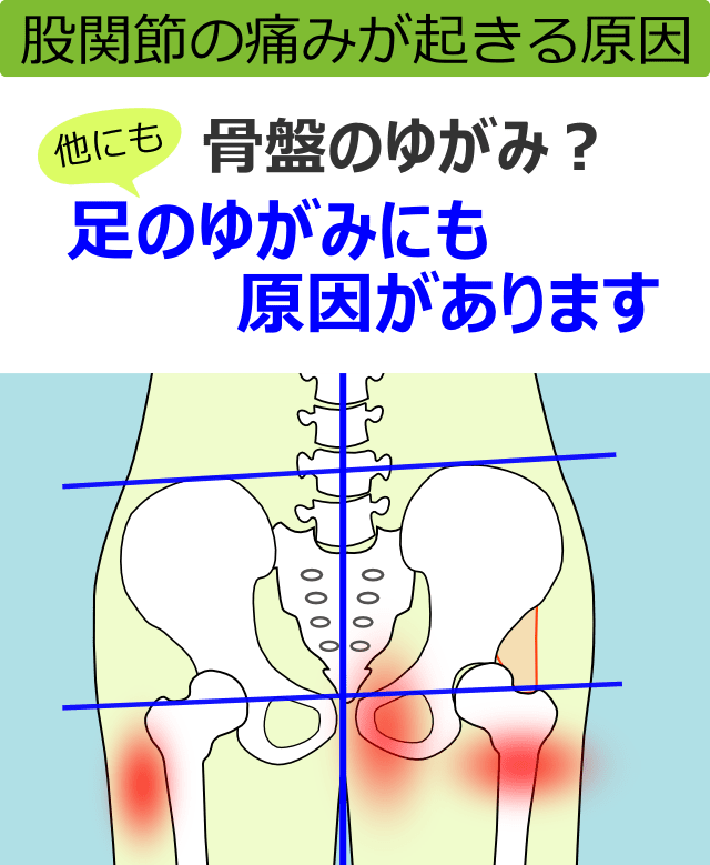 股関節の痛みが起きる原因