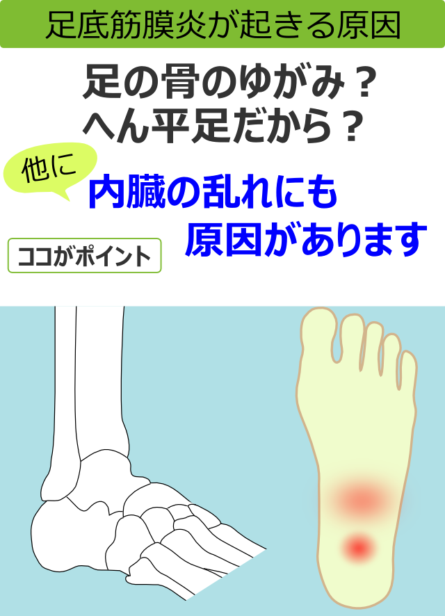 足底筋膜炎が起きる原因
